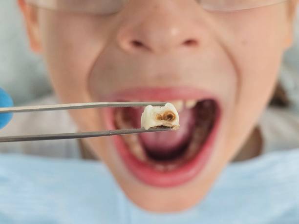 Best Emergency Root Canal Treatment in Lonville, GA